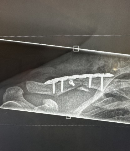 Kambach Röntgenbild